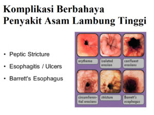 Illustration for article titled Obat Asam Lambung Tinggi Paling Ampuh